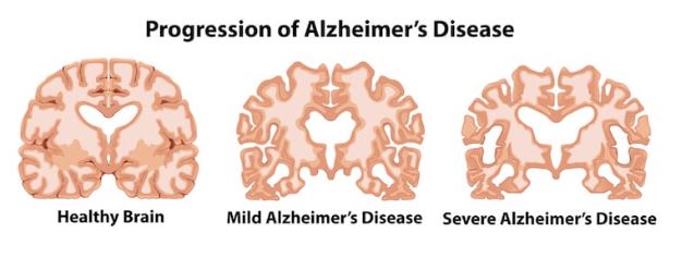 views of the brain in alzheimer's