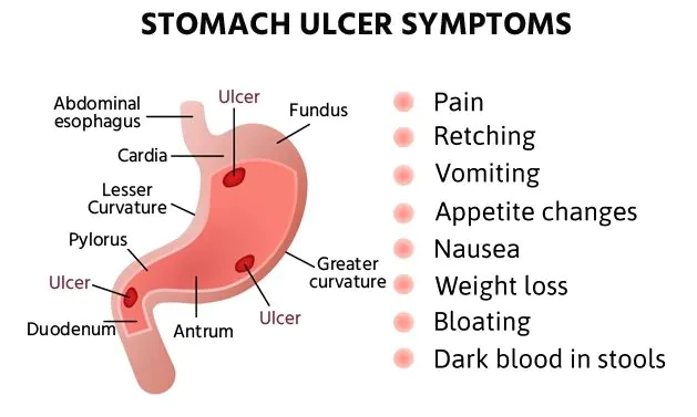 Scheme of stomach and ulcer symptoms